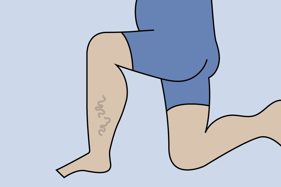 varicose